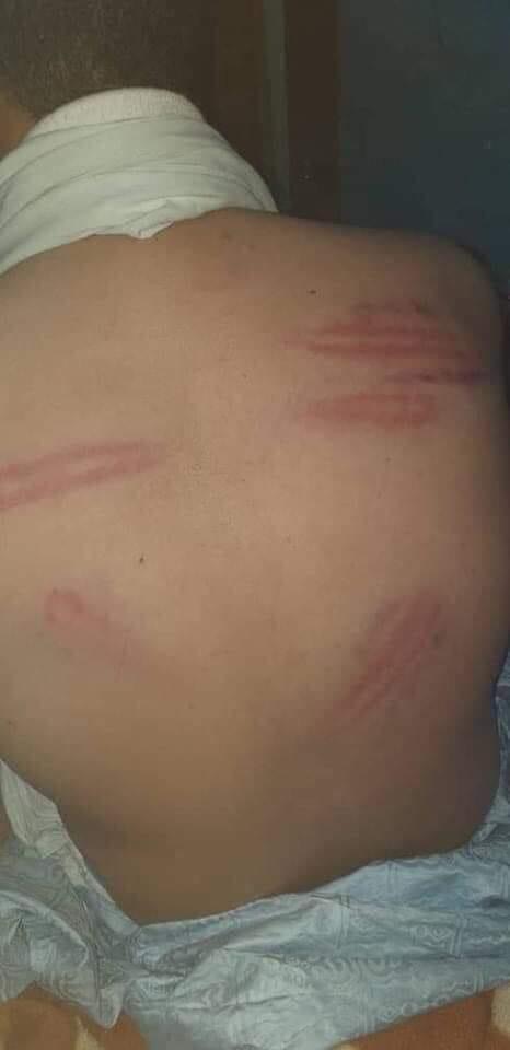 آثار التعذيب بادية على جسد الضحية عبد الله الفتى
